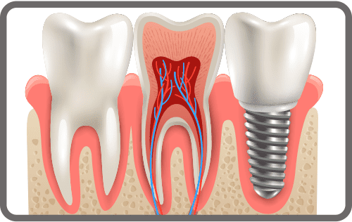 dental-implants-small
