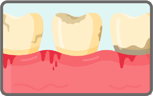 gum-disease-small