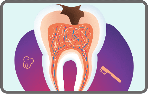 root-canal-small