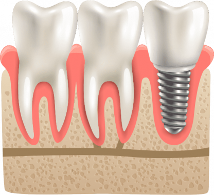 dental-implants